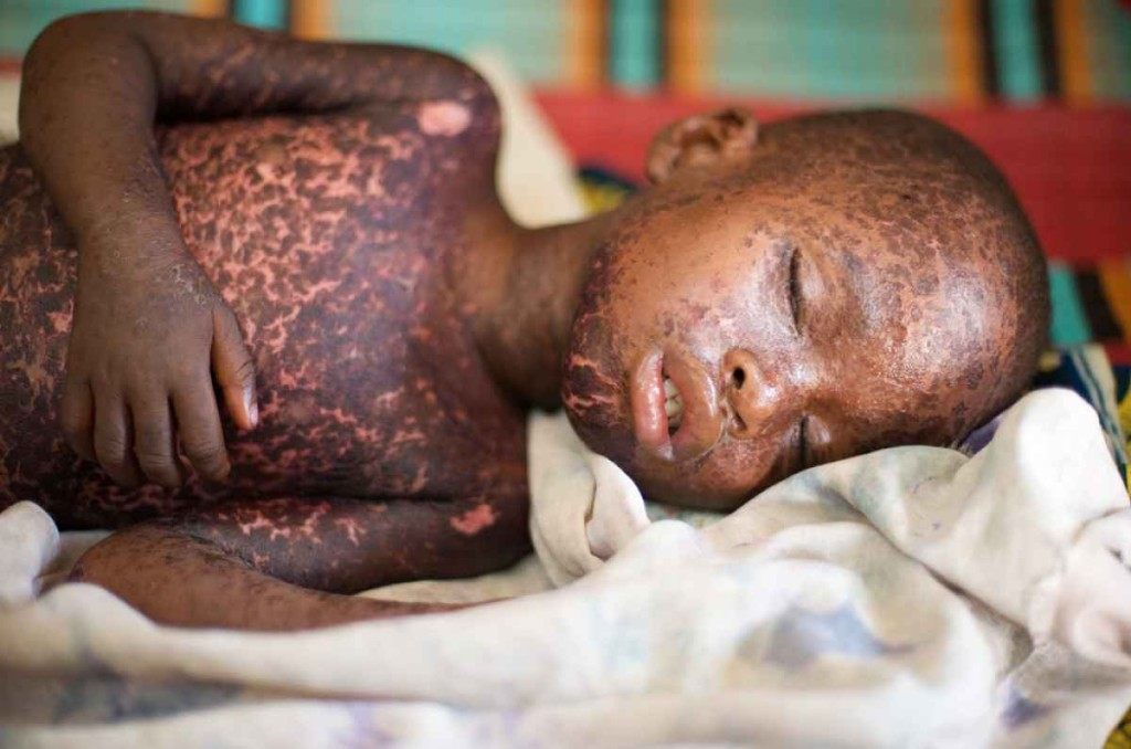 A child, without the vaccine, will become sick when exposed to measles.