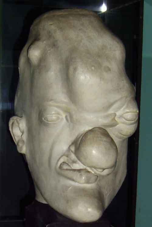 Bust displaying tertiary syphilis