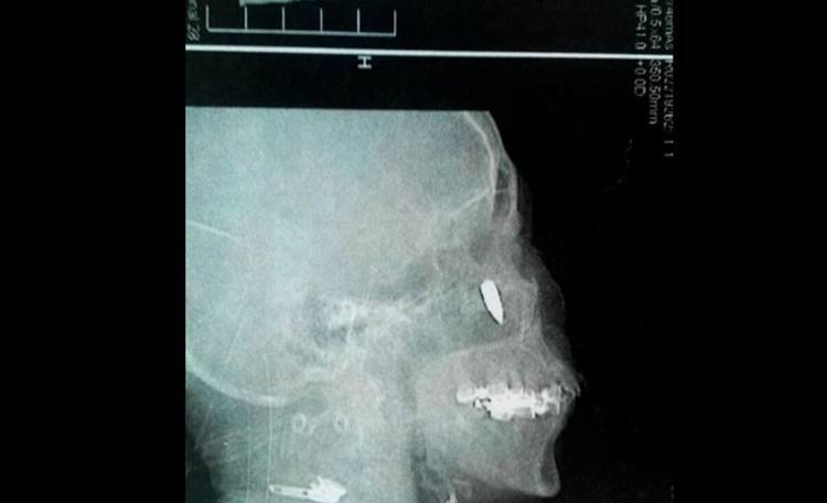 weirdest x-rays nose bullet