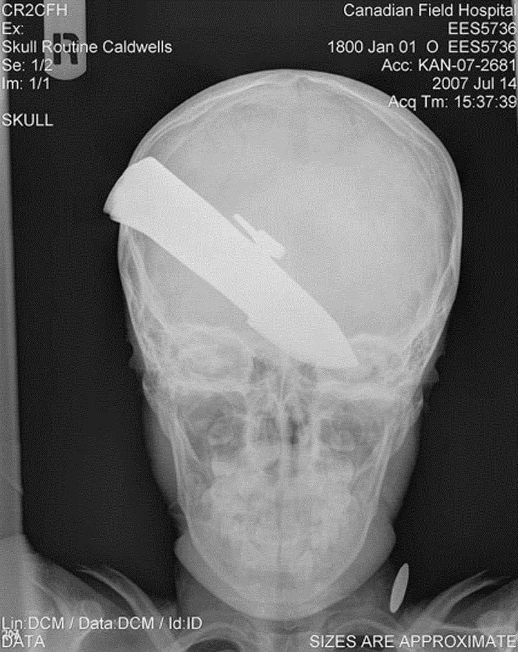 weirdest x-rays skull knife