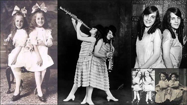 The Curious Life Of The Conjoined Hilton Sisters