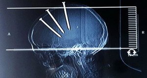 Weirdest X Rays Skulls Nails