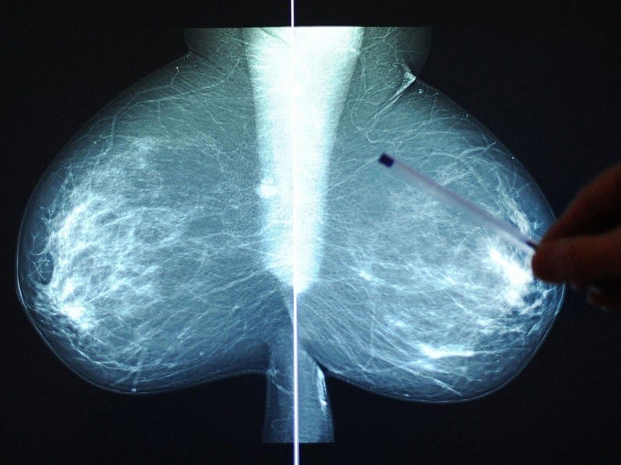 Breast Cancer X Ray