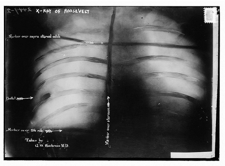 Theodore Roosevelt Bullet X Ray