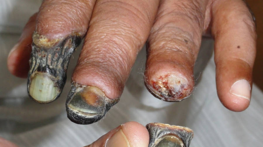 Krokodil Fingers Flesh Eaten