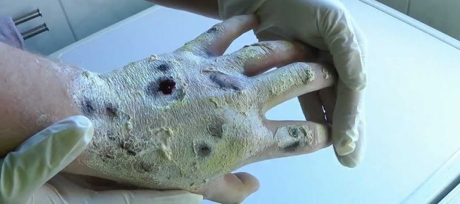 Krokodil Hand Flesh Eaten
