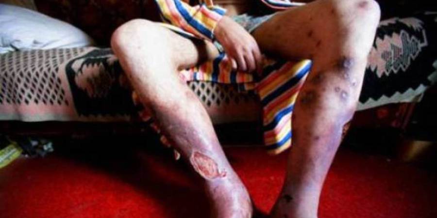 Krokodil Leg Flesh Eaten