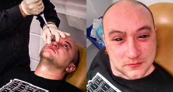 Biohacking Black Eyes