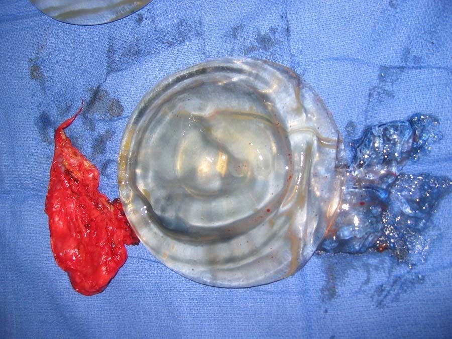 Ruptured Breast Implant