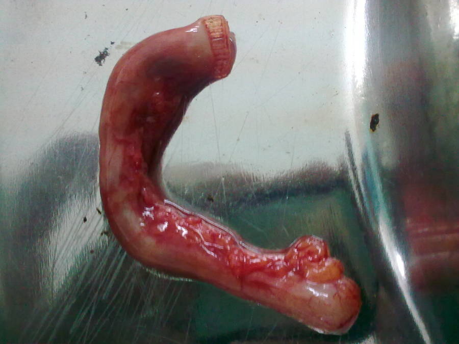 Removed Human Appendix