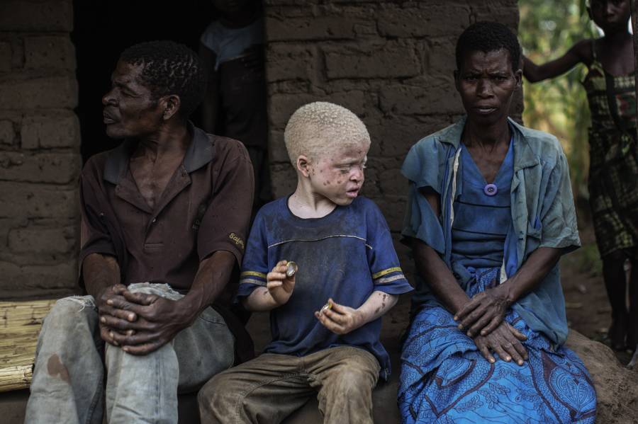 Albino Child