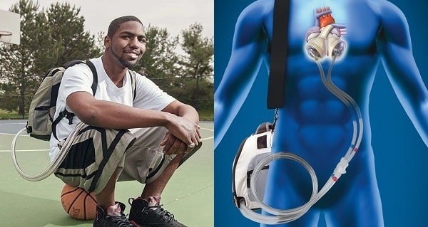 How One Man Lived 555 Days With No Heart In His Body