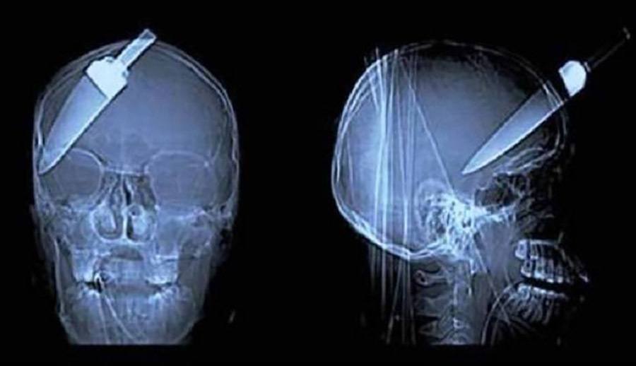 Knife In Head X-Ray