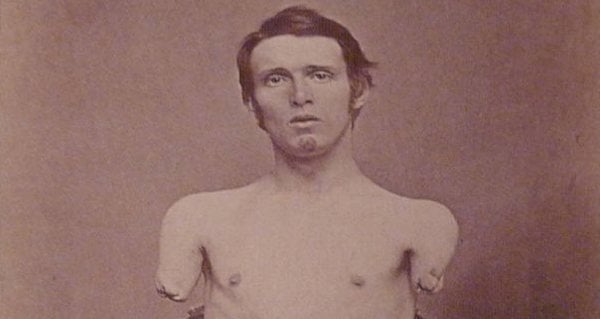[Image: alfred-a-stratton-injuries.jpg]