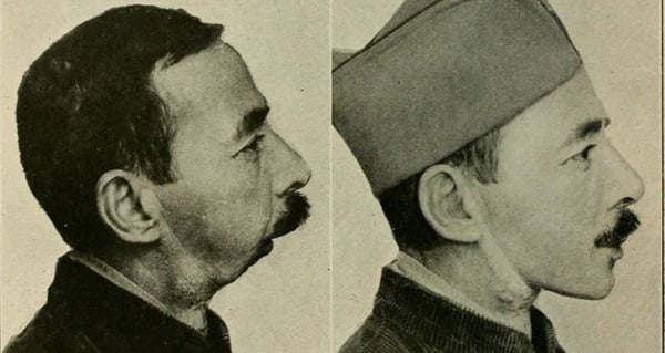 Man Missing Jaw Comparison