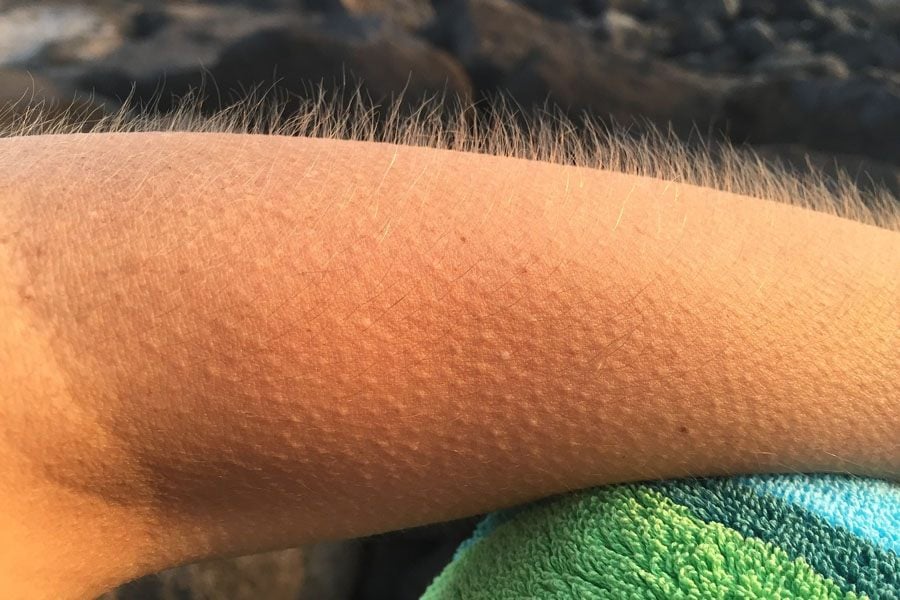 why-do-humans-get-goosebumps-when-they-are-cold-or-under-other