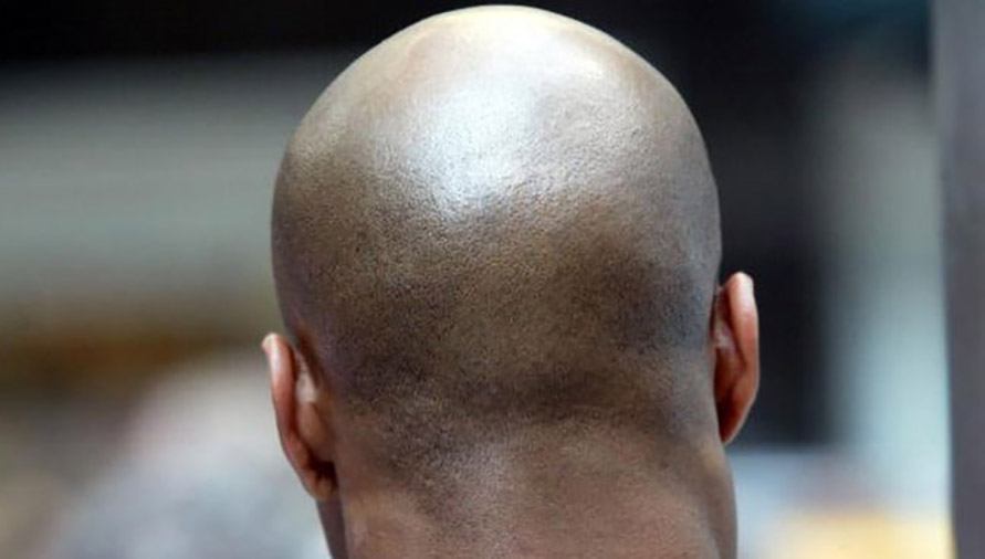 Bald Back