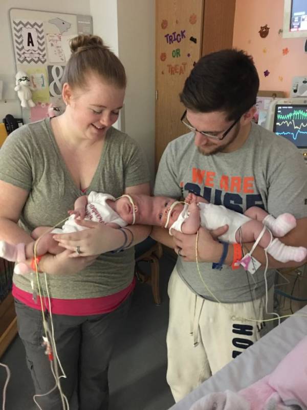 Conjoined Twins With Parents