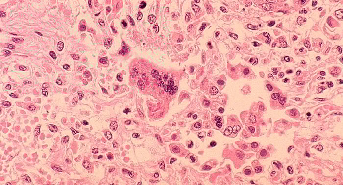 Measles Pneumonia