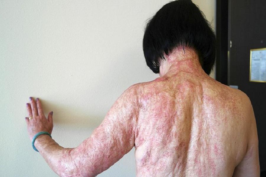 Napalm Girl Burn Scars