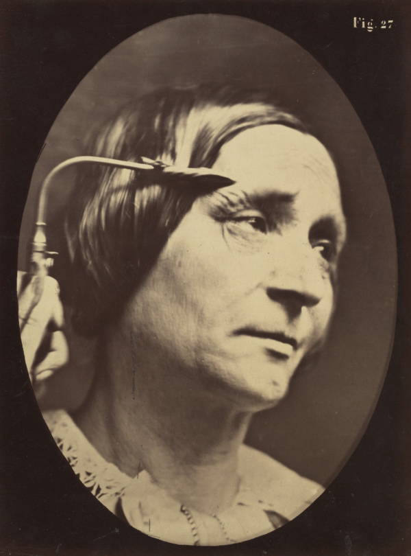 Photos Of Duchenne de Boulogne's Experiments On The Human Face