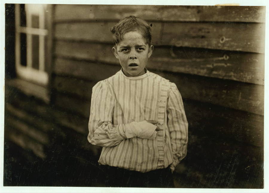 Injured Child Mill Worker