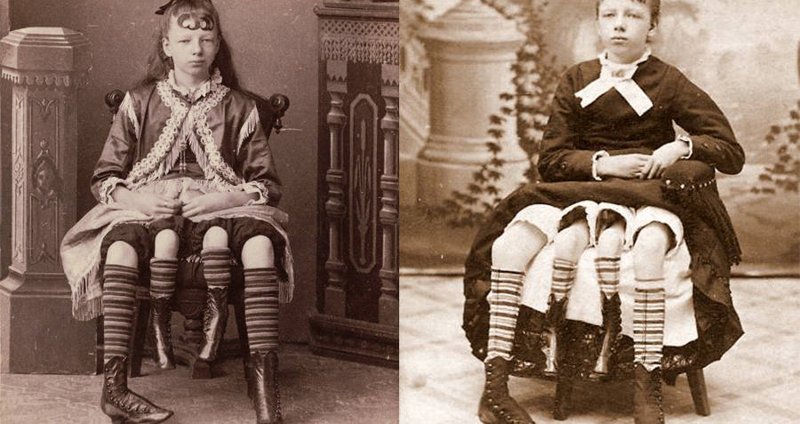 Myrtle Corbin four legged woman