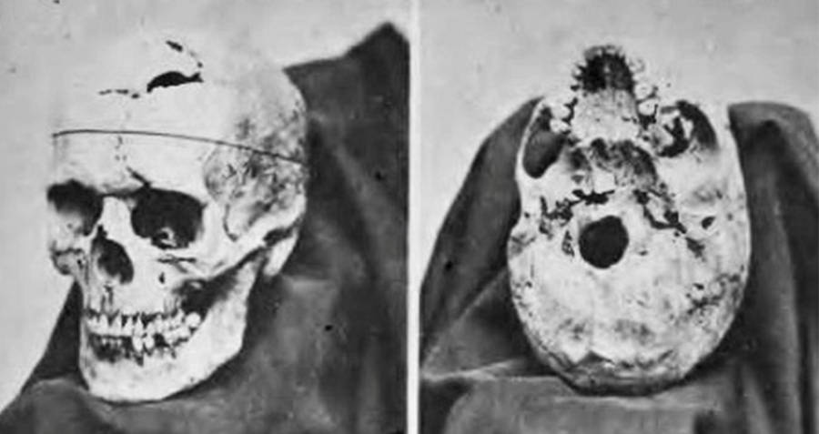 Phineas Gage's Skull