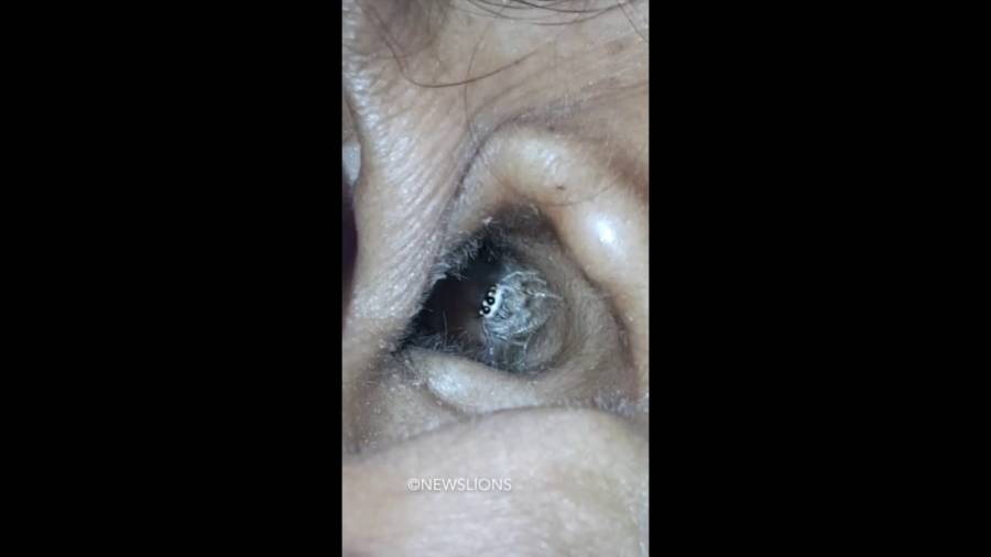 Doctors Find Spider Living In Womans Ear Video