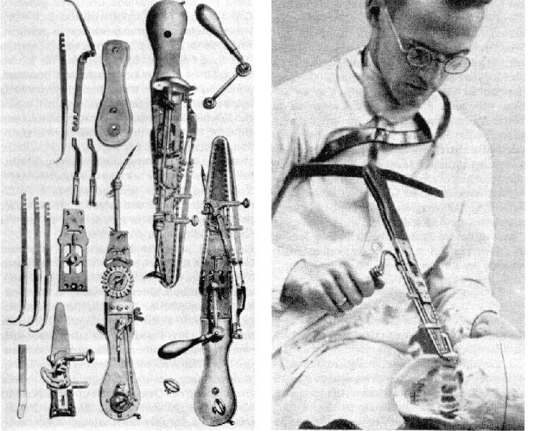 Symphysiotomy The Brutal History Of Chainsaw Childbirth 