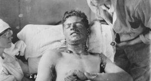 Mustard Gas Patient