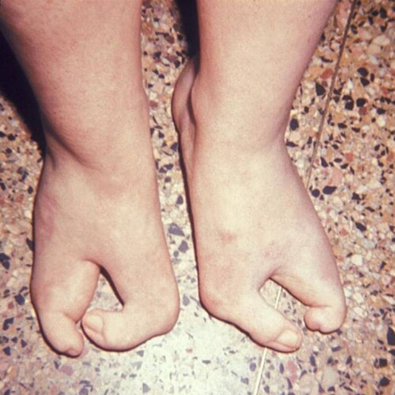 Ectrodactyly Feet