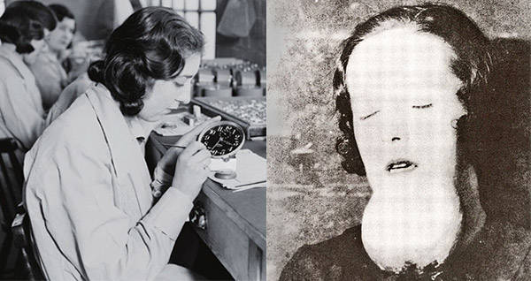 radium girls deformities