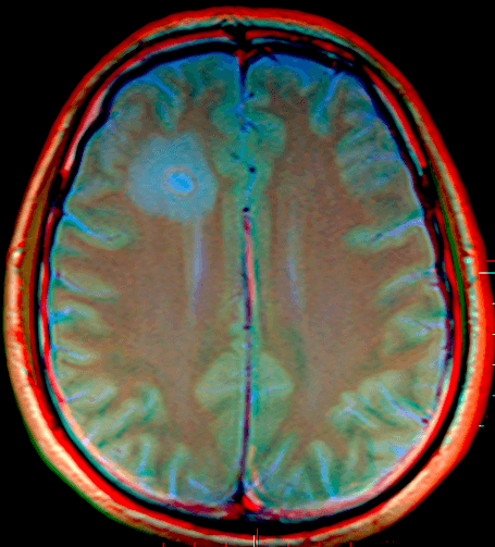 A Brain MRI
