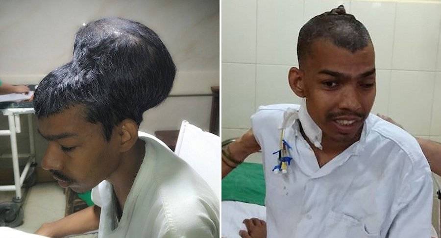 Doctors In India Remove The World s Largest Brain Tumor