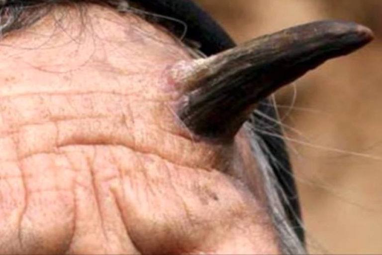 cutaneous-horn-the-skin-growth-that-turns-humans-into-unicorns