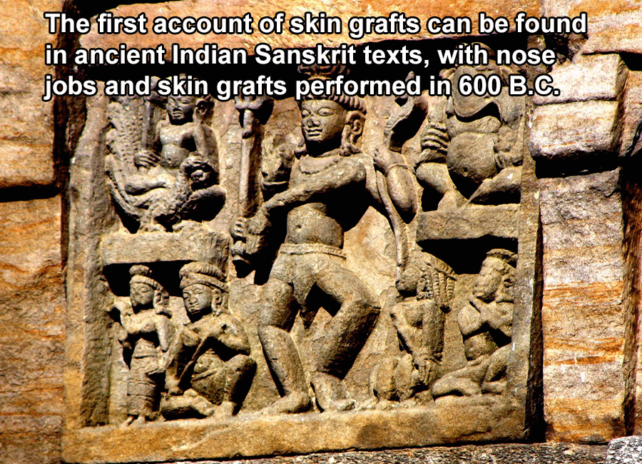 Indian Skin Grafts