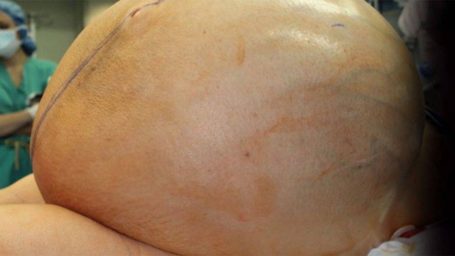 Ovarian Tumor