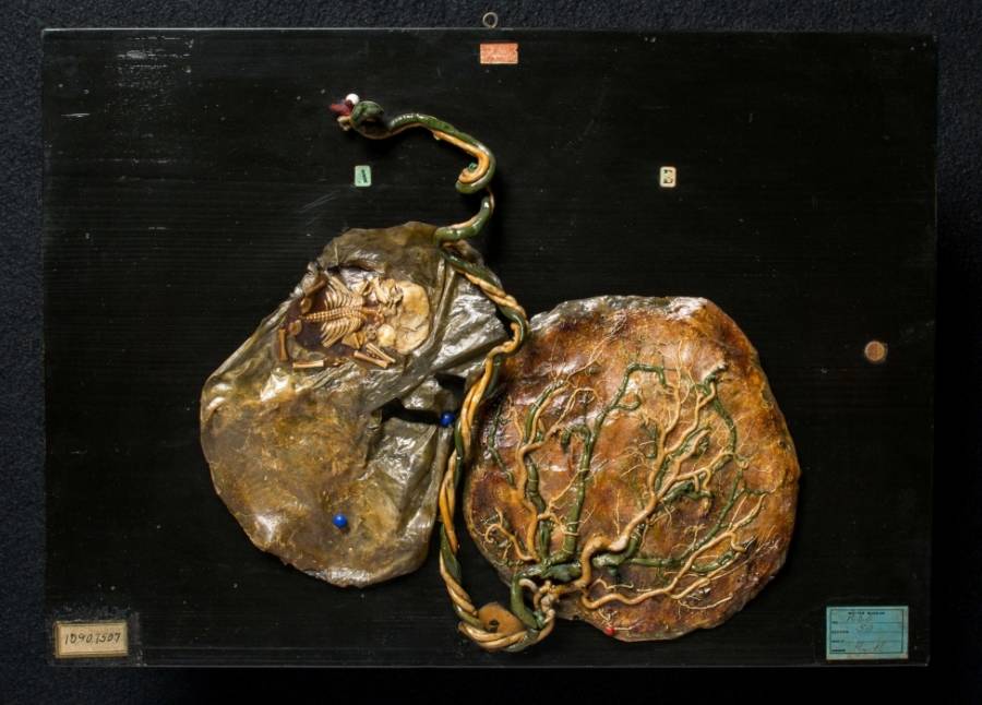 The Mütter Museum's 25 Most Curious And Grotesque Medical Oddities