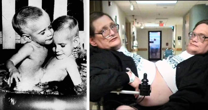 Oldest-ever conjoined twins Ronnie and Donnie dead at 68