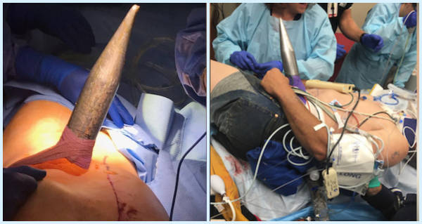 Spear Surgery Operation
