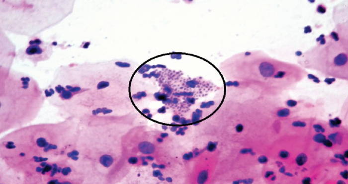 Donovanosis Granuloma Inguinale: The Flesh-Eating STD