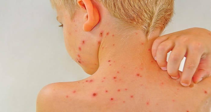 11-month-old-baby-suffers-a-stroke-months-after-contracting-chickenpox