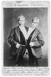 Conjoined Twins: What It's Like To Be Literally Joined At The Hip