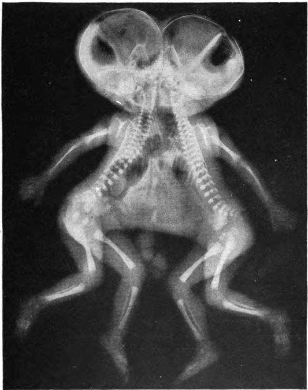 Conjoined X Ray