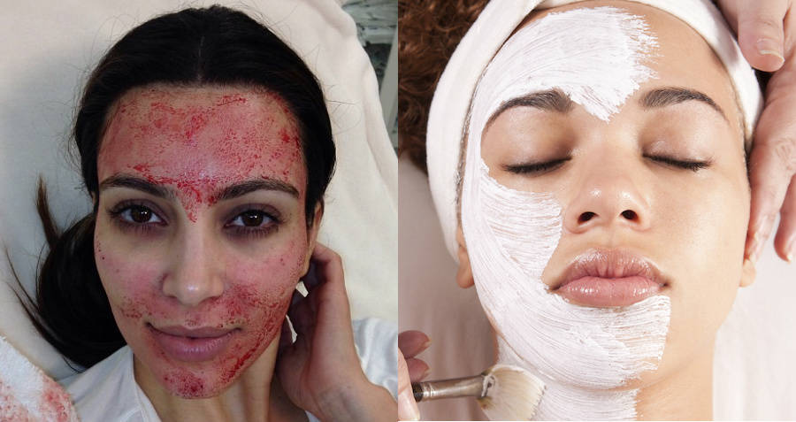 Vampire Facial Feat