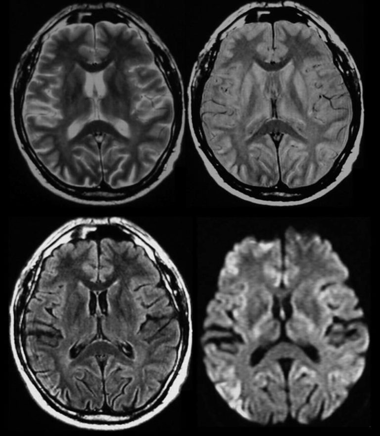 Eating Squirrel Brains May Have Given This Man Mad-Cow-Like Disease