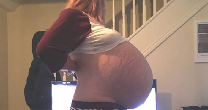 57 Pound Ovarian Cyst