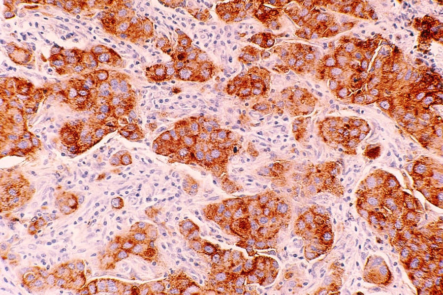 Ductal Carcinoma Cells