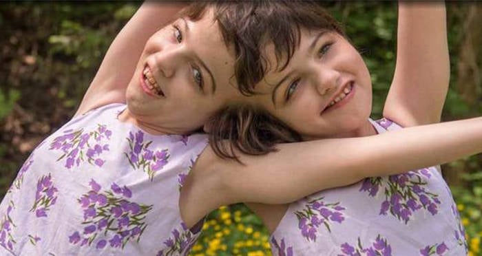 abby and brittany hensel conjoined twins sex life